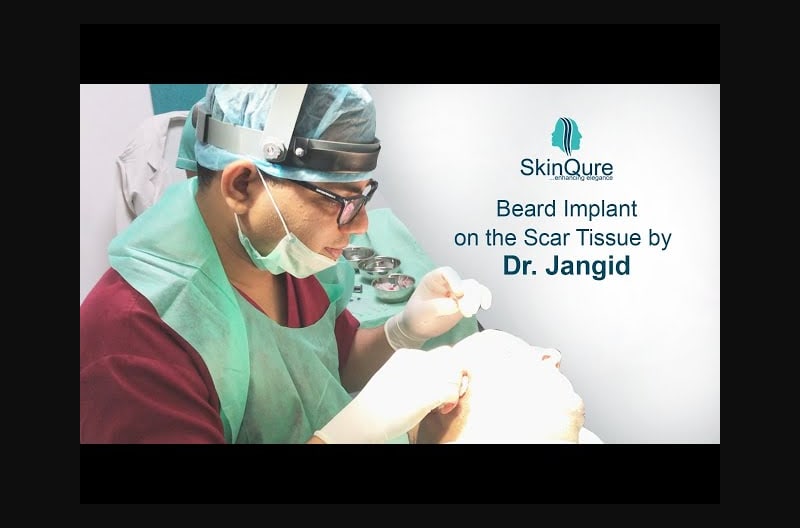 Watch Dr. Jangid performing beard transplantation on the affected Scar tissue.