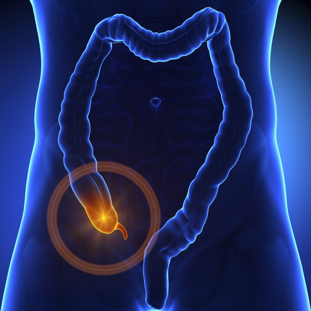 Surgery for appendicitis? Antibiotics alone may be enough
