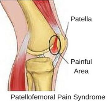 Patellofemoral Pain Syndrome Exercises & Treatment Plan - Your Health Guideline