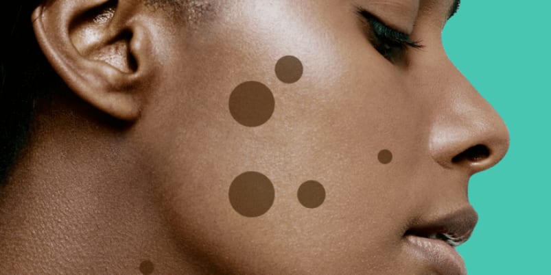 9 Dark Spot Treatments That Really Work, According to Dermatologists