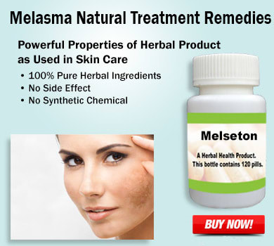 Home Remedies for Melasma Need to Know About Prevention and Precautions - Herbs Solutions By Nature