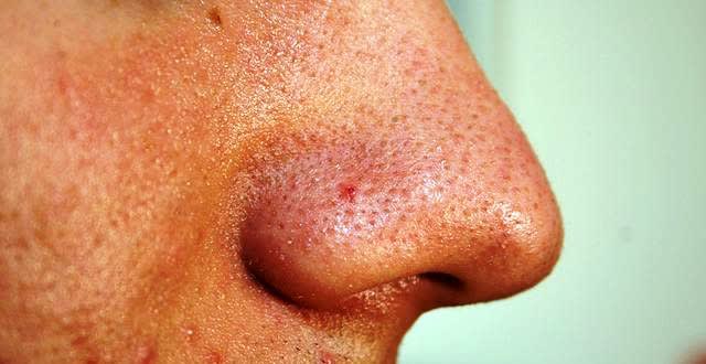 How to Get Rid of Blackheads: Top 5 Home Remedies