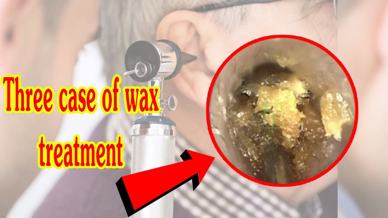 Three case of wax treatment 2020
