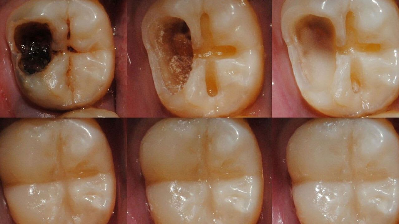 Scientists Develop Gel That Can Regrow Tooth Enamel