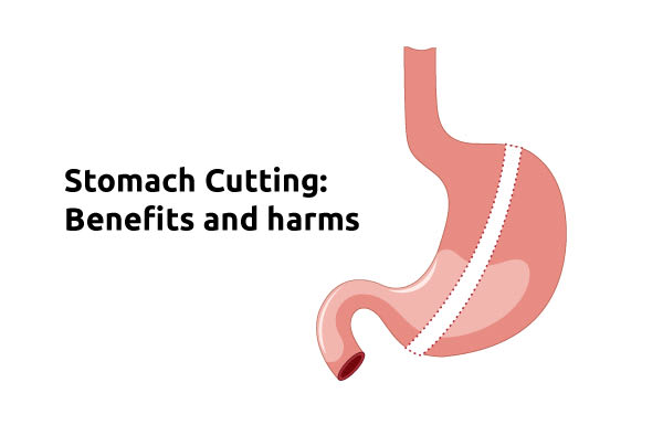 Stomach Cutting: Benefits and Harms