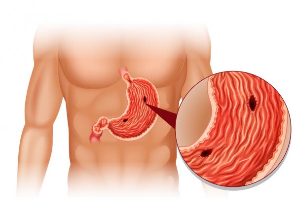 7 Simple Tips To Better Manage Stomach Ulcer