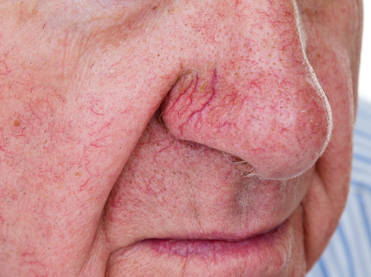 How Can I Get Rid of the Spider Veins on My Face?