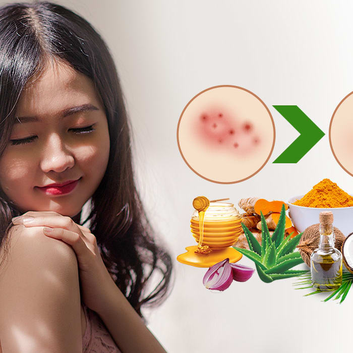 6 important Natural Remedies for acne scar treatment!