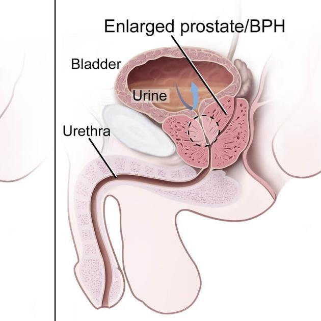 Prostate Cancer: Symptoms, Diagnosis, Prevention, Gay prostate cancer