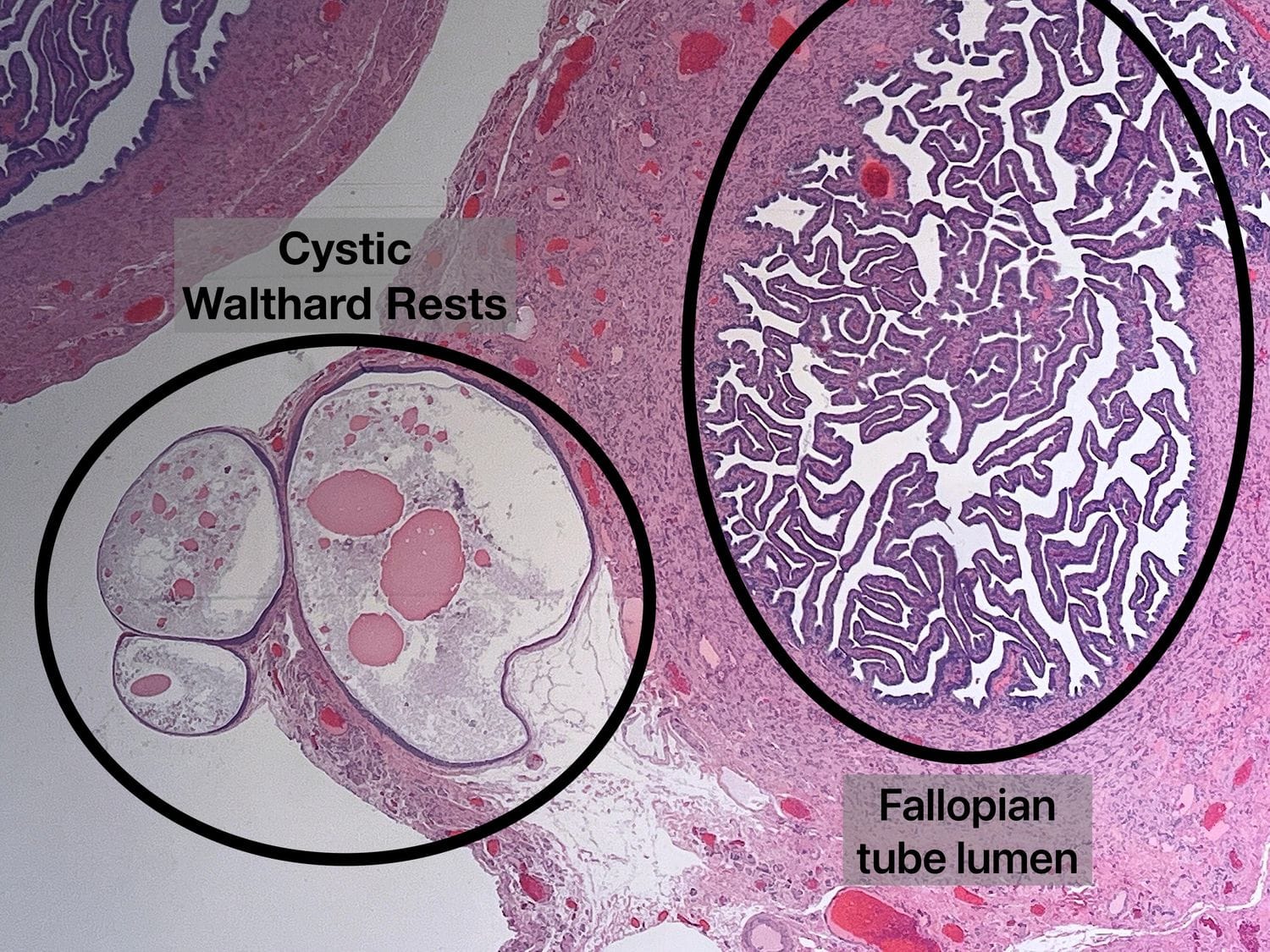 Histology lesson: Fallopian tubes can have cysts called 