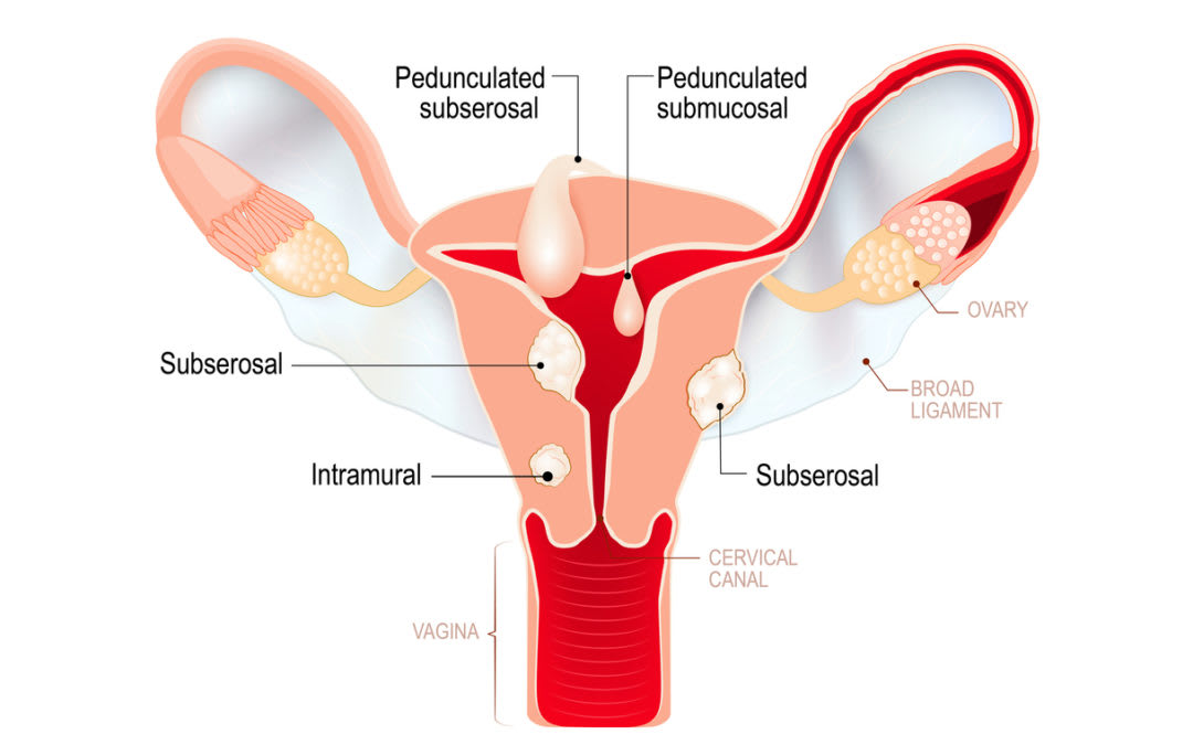 Surgical options for Uterine Fibroids