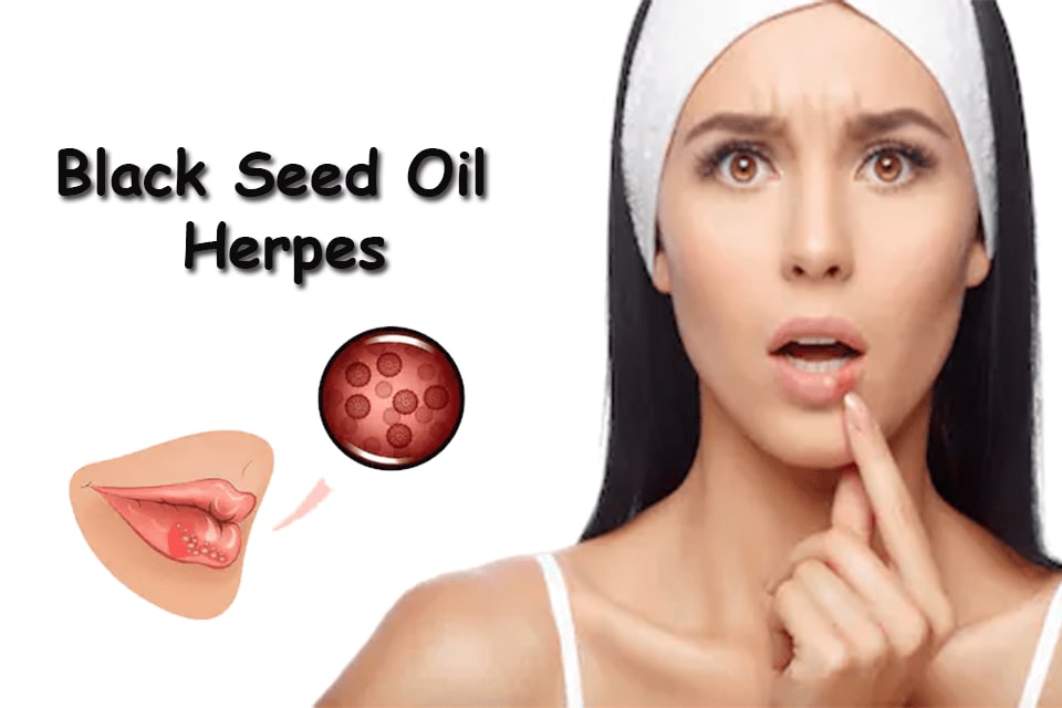 Does Black Seed Oil Herpes is an Effective Regime