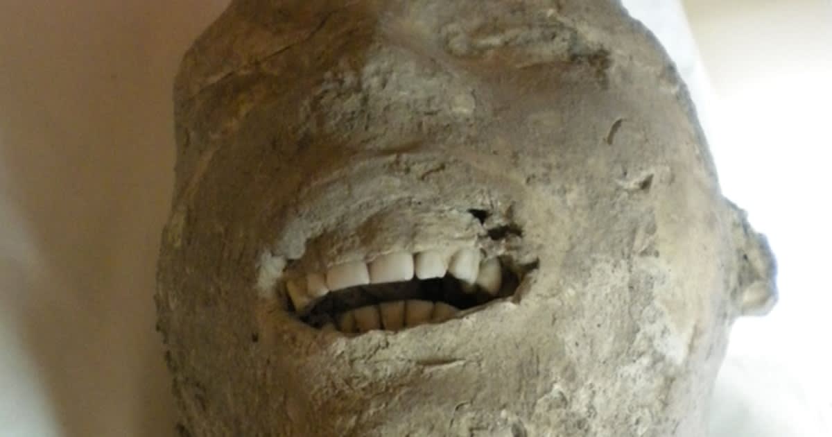 The teeth of a victim of the Vesuvius eruption that destroyed Pompeii 2000 years ago: they were in perfect condition in life, due to a combination of dietary and environmental factors, and remain so to this day