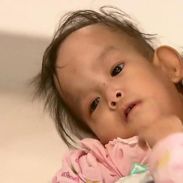 Conjoined Bhutanese twins separated after six-hour surgery