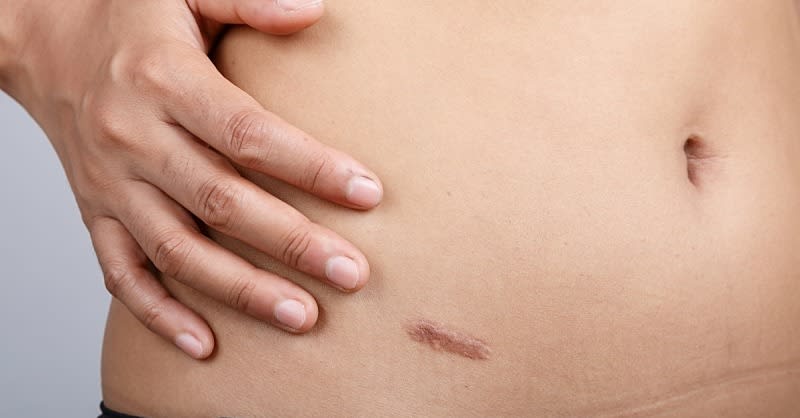 How to Get Rid of Raised Scars Once and for All