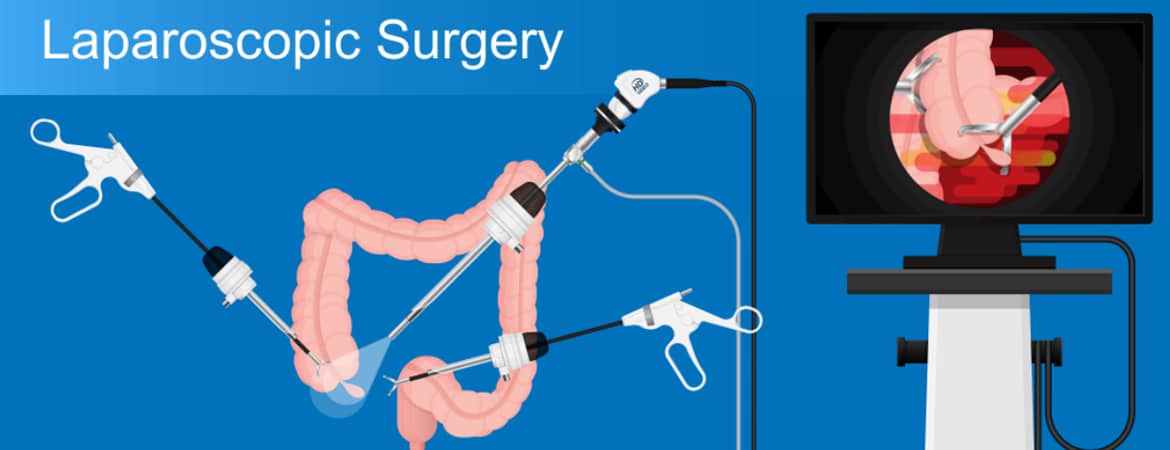 Know About Laparoscopic Surgery And Its Advantages - Bhagirathi Neotia
