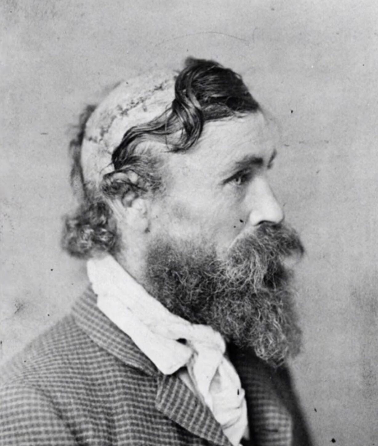 Robert McGee, the man who was scalped as a child by native Americans 1864