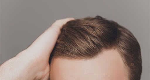 How Long Does It Take To Recover From Hair Transplant Surgery?