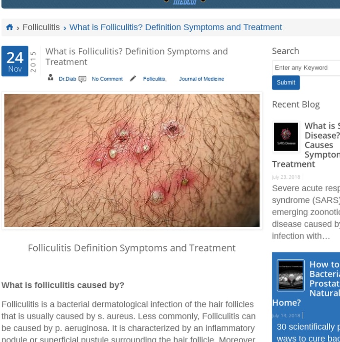What is Folliculitis? Definition Symptoms and Treatment