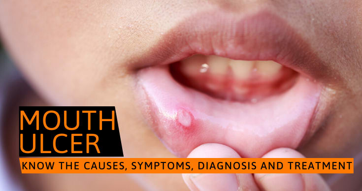Mouth Ulcer? Know The Causes, Symptoms, Diagnosis And Treatment