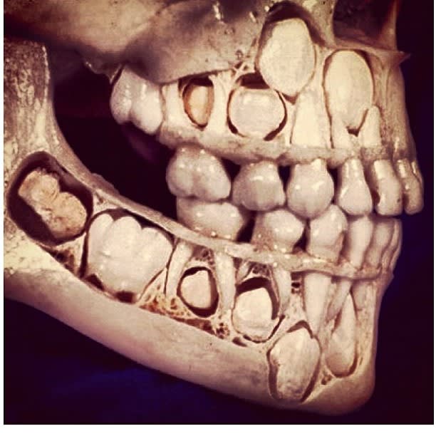 A toddler skull. Look at all those teeth! This is both super cool &...Oddly Terrifying.