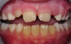 Why Are Childs Permanent Teeth Growing In Yellow
