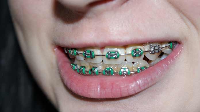 Good to know: How do I know I need braces for my teeth