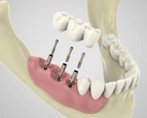 Implants dentaires en Tunisie
