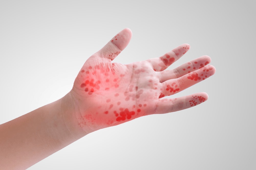 Effects Of Hand Foot And Mouth Disease In Adults