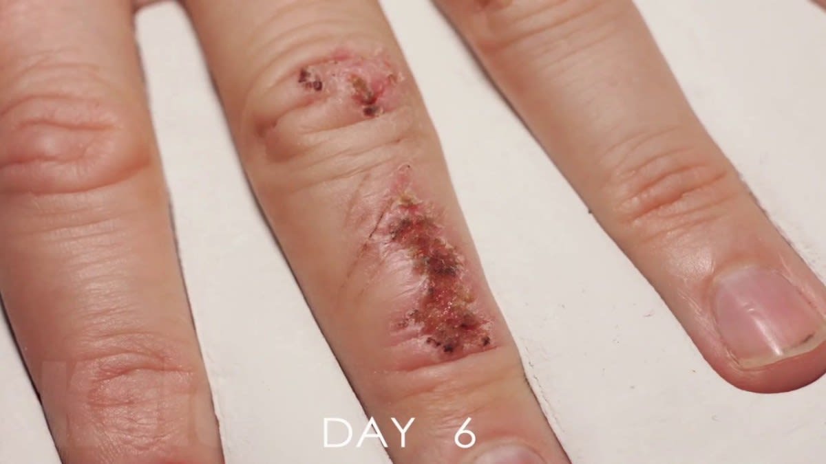 Watch this time-lapse video of a wounded finger healing