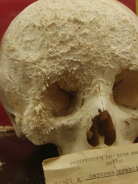 Skull of a person, who had bone cancer