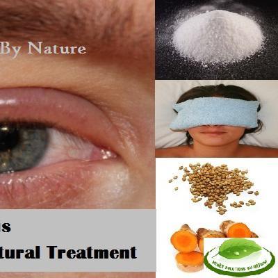 5 Home Based Natural Treatment for Blepharitis