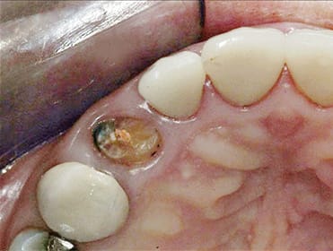 Implant placement vs. tooth retention