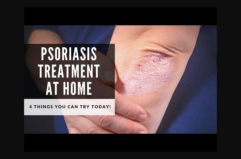 Psoriasis Treatment at Home - 4 Things You Can Start Today!