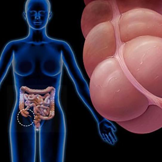 What Is Appendix Cancer?