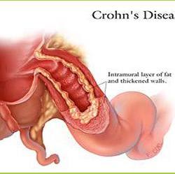 Crohns Treatment in India, Stem Cell Therapy for #Crohns