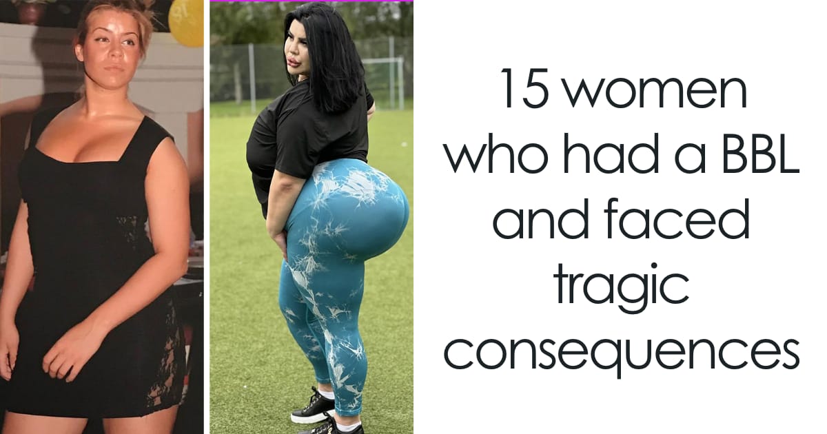 “She Learned Her Lesson”: 15 Times BBL Surgeries Went Horribly Wrong