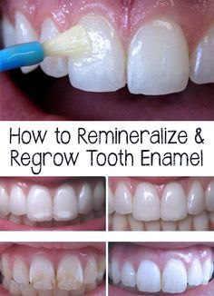 Tooth Enamel - How to Remineralize & Regrow Tooth Enamel