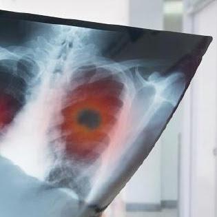 New technology may detect early-stage lung cancer