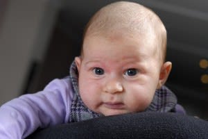 Eczema in Babies-Baby Recipes-Eczema is a fairly common skin condition