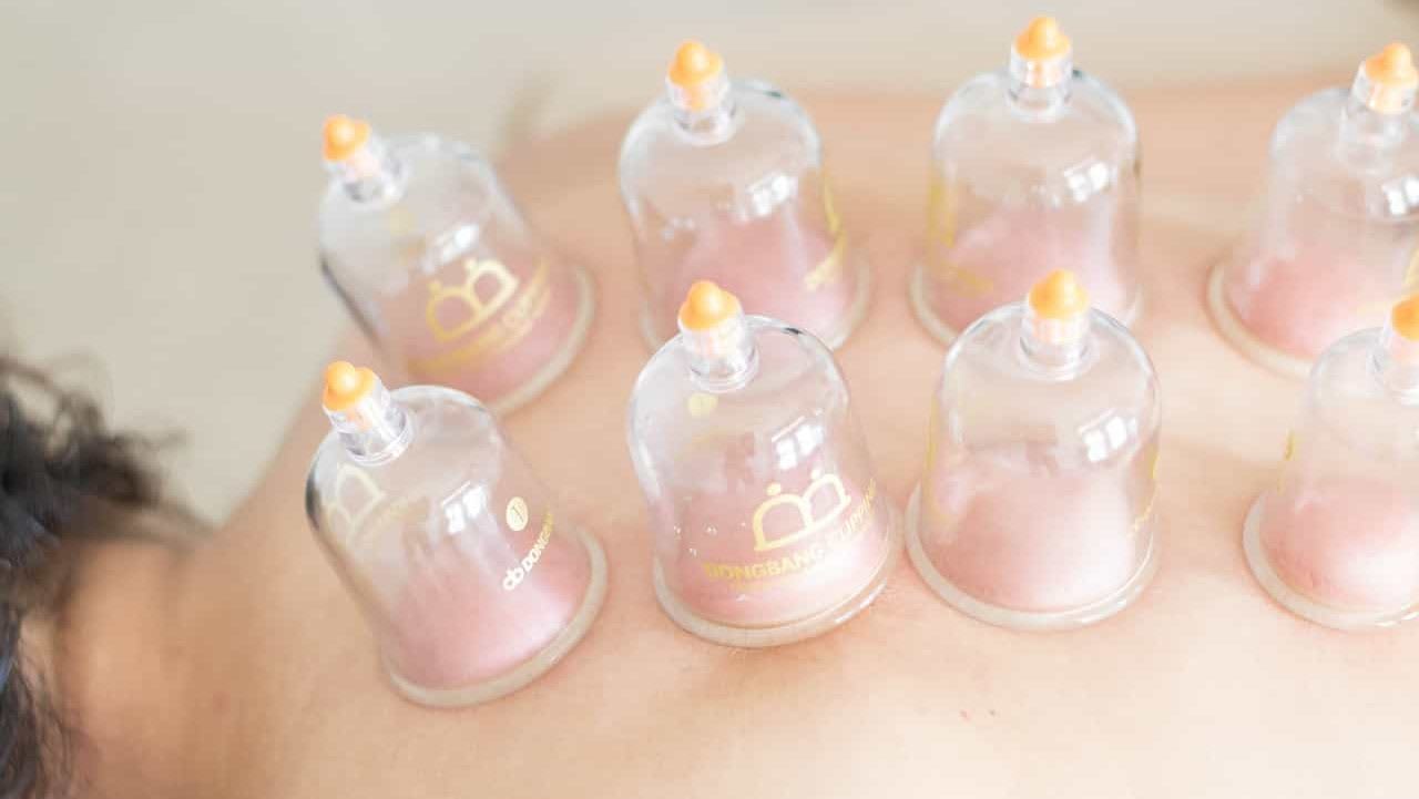 How Cupping Could Bring Relief for Fibromyalgia
