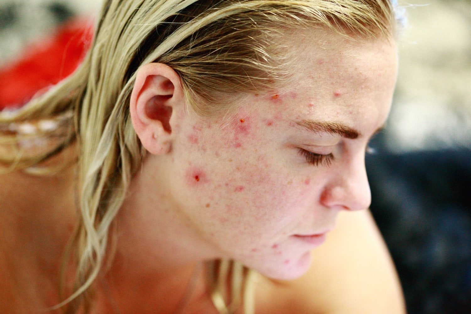 Rosacea: Causes, Triggers, And Skincare Routine For Rosacea