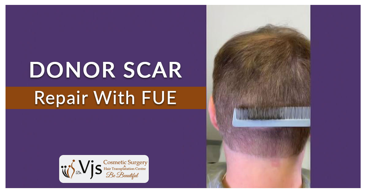 Donor scar repair with FUE
