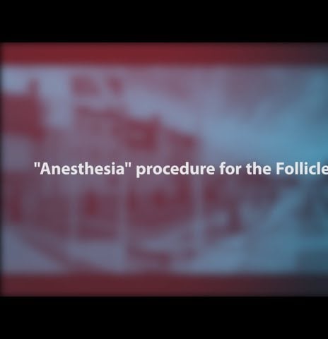 Anesthesia procedure for the Follicles puncture