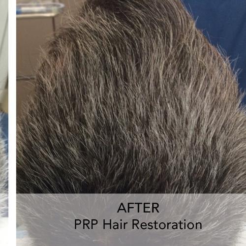 Hair Loss: Platelet Rich Plasma is a Non-Surgical Option - Natural Look Medical Spa
