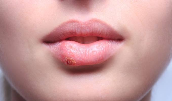 Why Your Partner Is Mum About Herpes