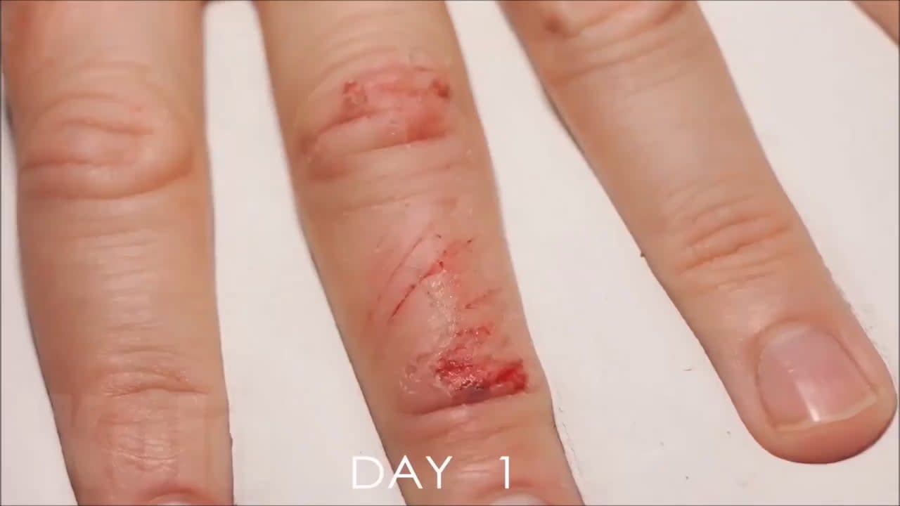Timelapse of the human healing process