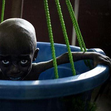 The battle to save Central African Republic's starving children