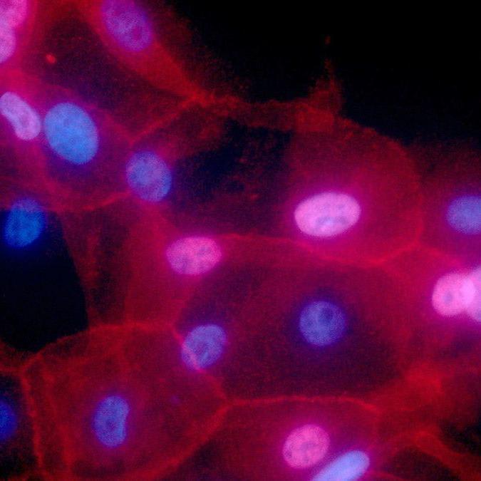 Immunotherapy scores a first win against some breast cancers - Los Angeles Times