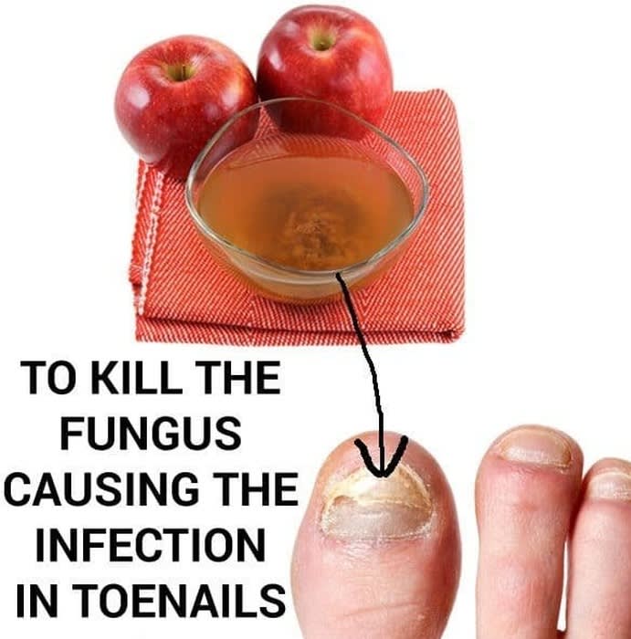10 Remedies to Fight Toenail Fungus at Home